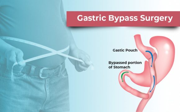 Gastric Bypass Surgery