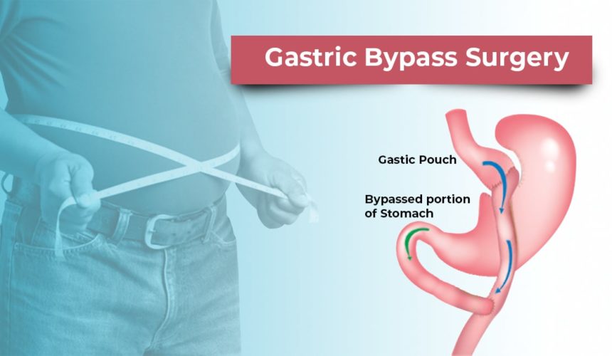 Gastric Bypass Surgery - NObesity
