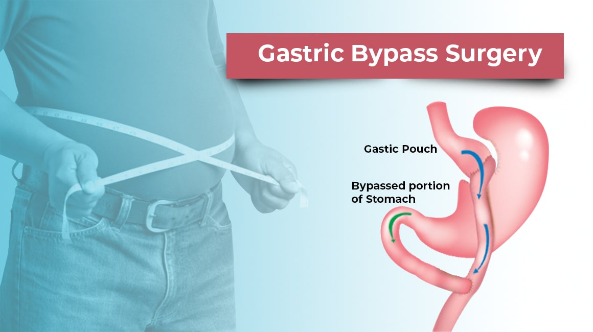 Gastric Bypass Surgery Nobesity Ahmedabad