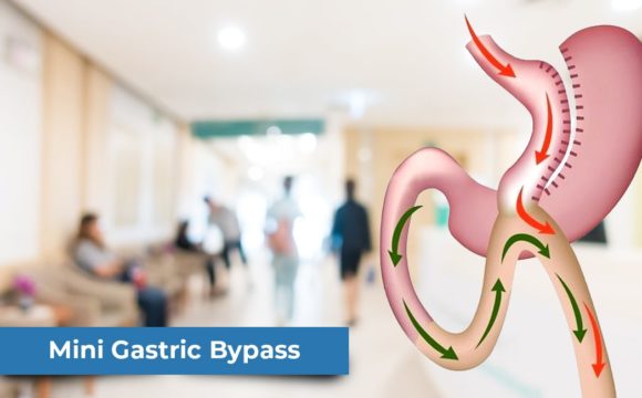 Mini Gastric Bypass