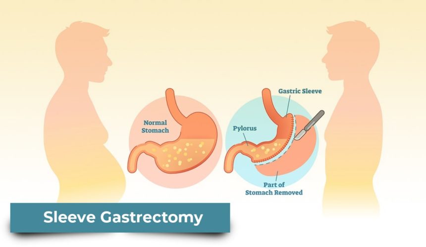 Sleeve Gastrectomy - NObesity