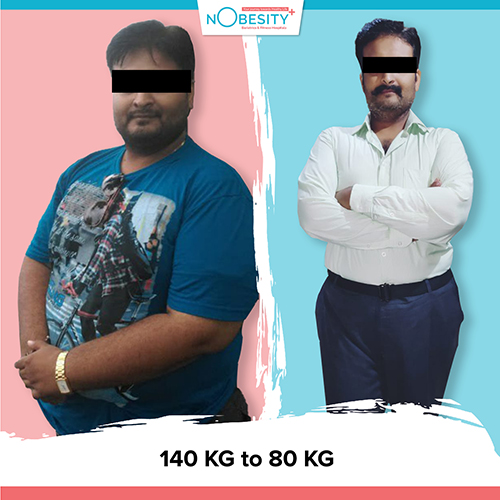 Before And After Weight Loss Surgery at Nobesity ahmedabad