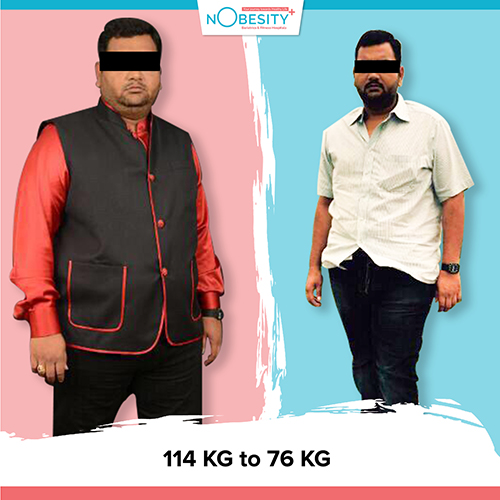 Before And After Weight Loss Surgery at Nobesity Clinic in ahmedabad