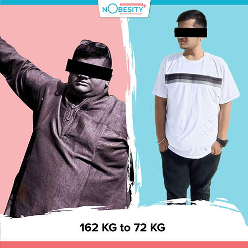 Before And After Weight Loss Surgery in Ahmedabad
