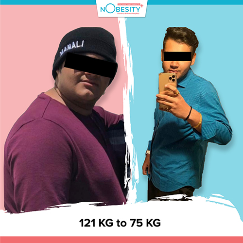 Before And After Weight Loss Surgery at Nobesity