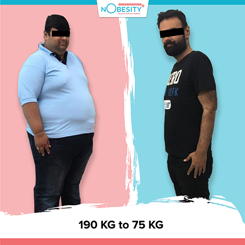 Before And After Surgery at Nobesity