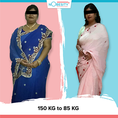 Before And After Weight Loss Surgery at Nobesity Clinic