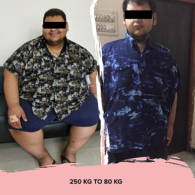 Before And After Weight Loss Surgery in Ahmedabad