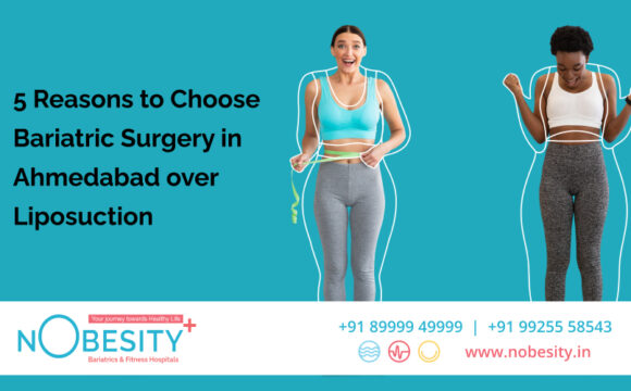 5 Reasons to Choose Bariatric Surgery in Ahmedabad over Liposuction