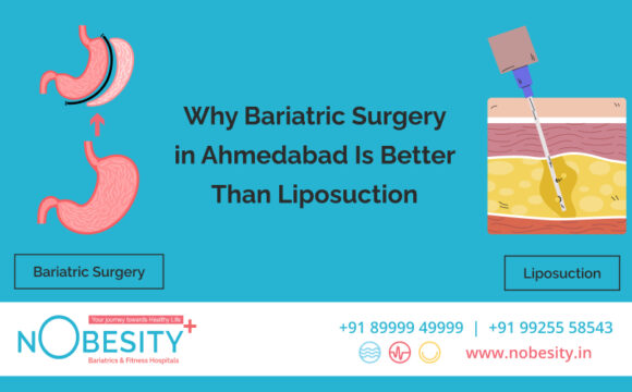 Why Bariatric Surgery in Ahmedabad Is Better Than Liposuction