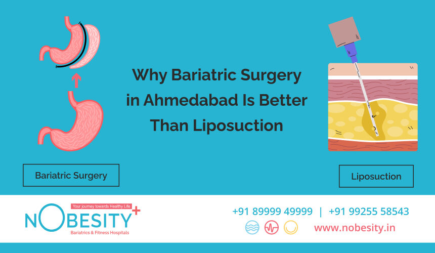 Why Bariatric Surgery in Ahmedabad Is Better Than Liposuction