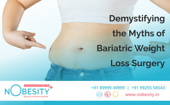 Demystifying the Myths of Bariatric Weight Loss Surgery