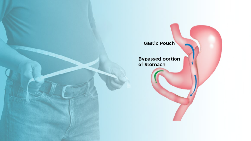Gastric Bypass Surgery Explanation